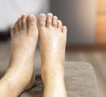 swollen feet are elevated when you raise the foot of the bed
