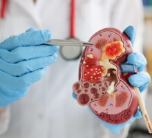urologist pointing at model of kidney