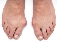 Funky feet with bunions
