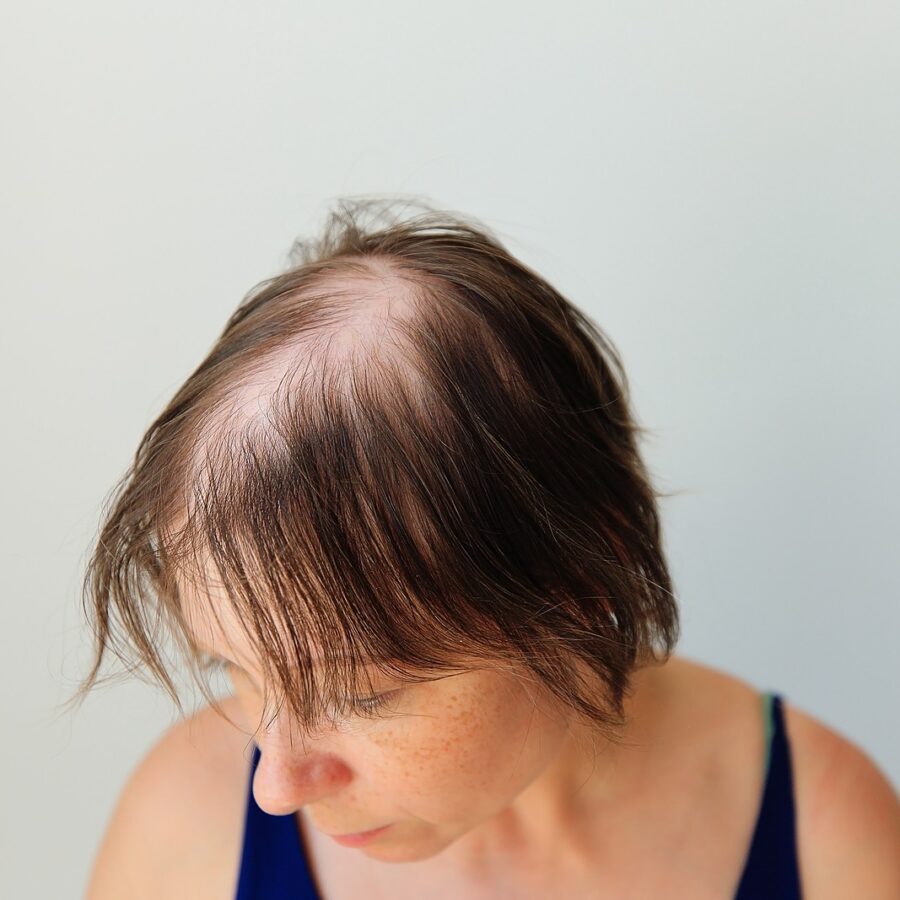 can semaglutide make your hair fall out Are Hair Loss or Colitis Side Effects of Wegovy and Ozempic?