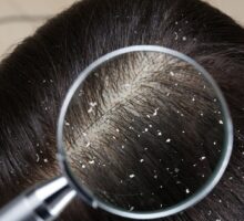 woman with dandruff in her hair