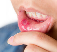 Canker sore on inner lower lip