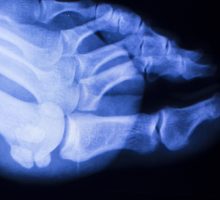xray test scan results of patient with arthritis and joints pain in feet