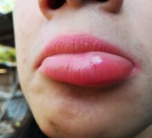 person with swollen lip called angioedema