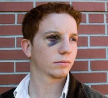 young man with a black eye