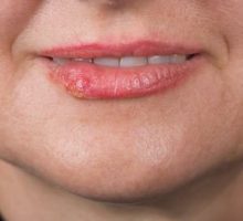 cold sore (herpes simplex) on woman's lip