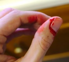 a cut finger bleeding