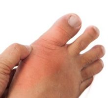 Hand embracing foot with deformed right toe due to painful gout inflammation