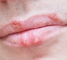 person with cold sores on lips