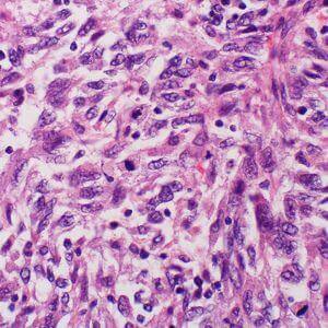 pathology slide of melanoma tissue