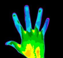 thermographic image of hand with multiple sclerosis
