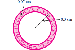 ARTERIOSCLEROSIS In arteriosclerosis, fatty material called plaque gradually builds up on the walls...-2