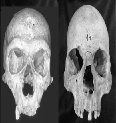 Examine the following photos. The Neanderthal is on the left with an anatomically modern human on...