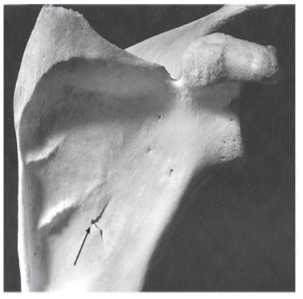 Examine the photograph below. Identify the trauma affecting this bone.