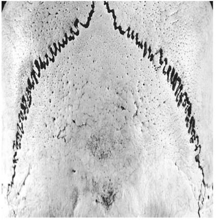 Examine the photograph below. Identify the pathological condition affecting this bone.