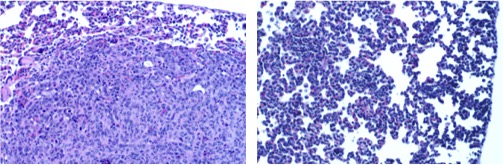 Rita Allen Foundation Scholar Robert Weinberg and his research team have shown that a transcription factor called Twist1, known for regulating embryonic development, also plays a key role in breast cancer metastasis. The image on the left shows a metastatic nodule in the lung of a mouse with a breast tumor. Knocking down the expression of Twist1 in breast tumor cells prevents metastasis—the image on the right shows normal lung tissue. (Images: Jing Yang)