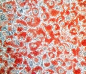 A culture of differentiated fat cells (adipocytes). Fat molecules are stained with the dye Oil Red O. Rita Allen Foundation Scholar Ajay Chawla has studied the role of the nuclear receptor PPARG in adipocyte differentiation. (Image: Wikimedia, Tirupathipichiah)