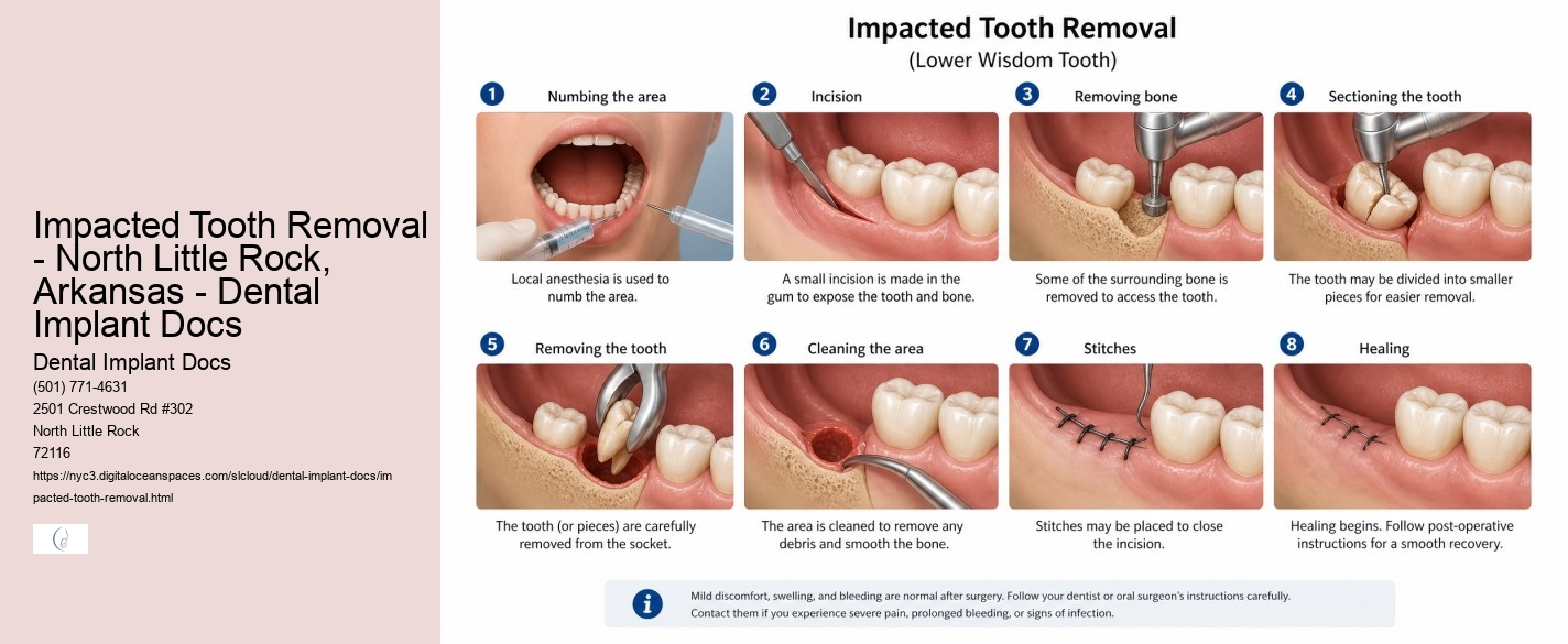 Impacted Tooth Removal - North Little Rock, Arkansas - Dental Implant Docs Dental Implant Docs Impacted Tooth Removal - North Little Rock, Arkansas - Dental Implant Docs