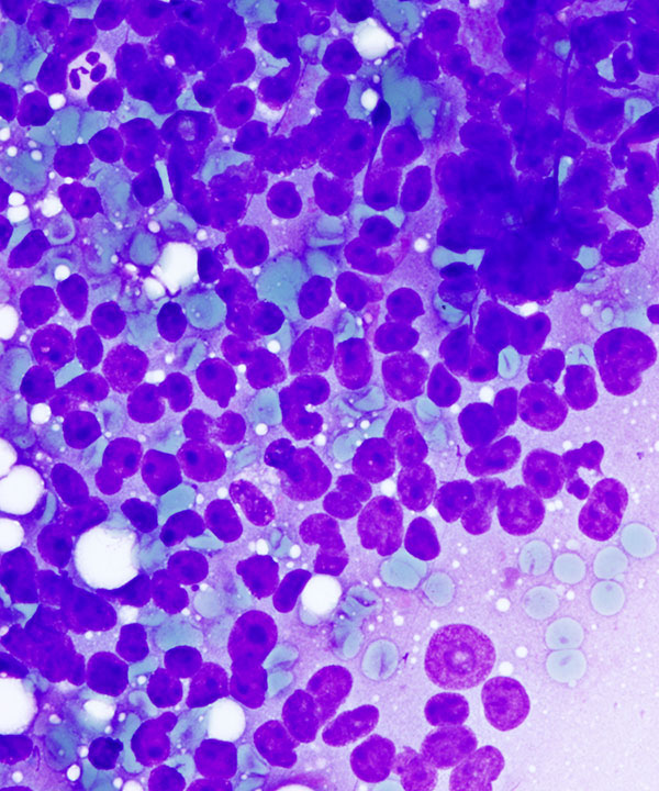 02 : Adrenal Gland Adrenocortical Carcinoma