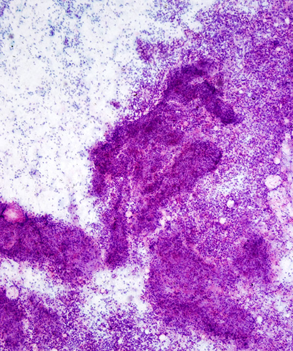 03 : Adrenal Gland Adrenocortical Carcinoma