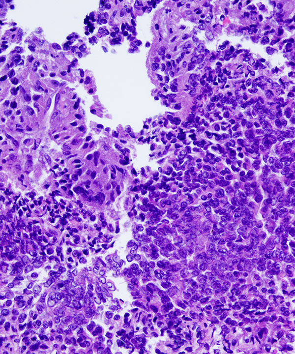 09 : Adrenal Gland Adrenocortical Carcinoma