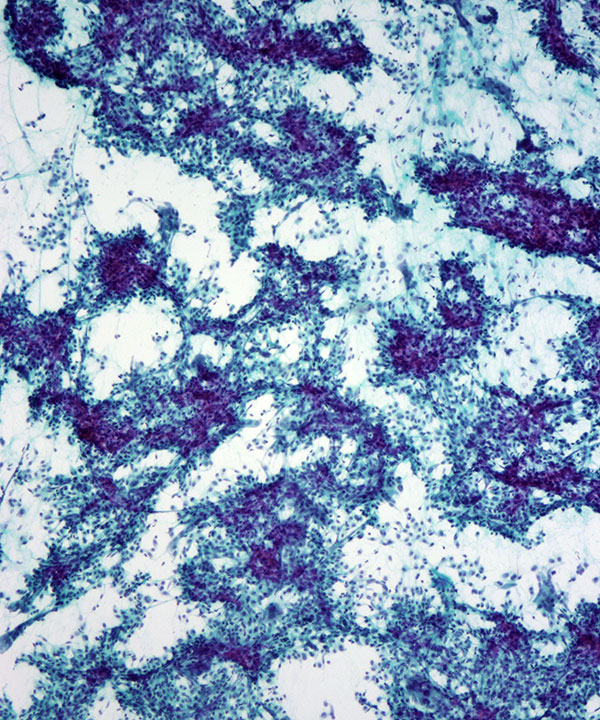 image showing 'Giant Cell Tumor'