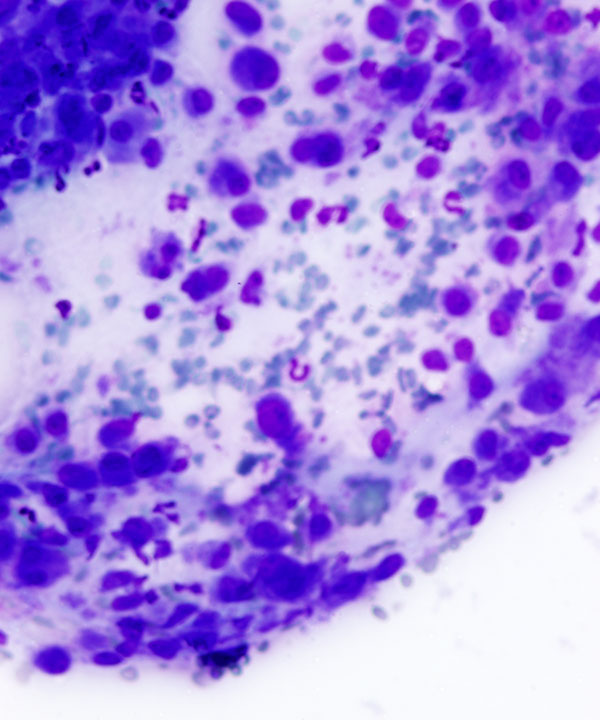 image showing 'Chondroblastoma'