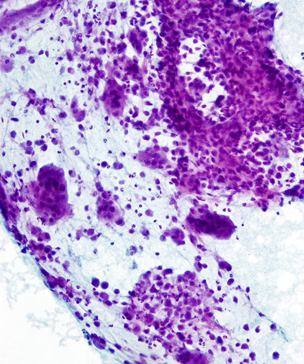 03 : Bone  Soft Tissue Chondroblastoma