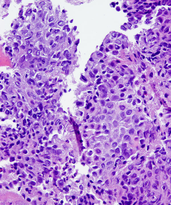 05 : Bone  Soft Tissue Chondroblastoma