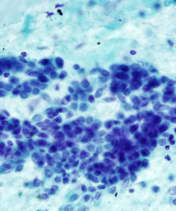 10 : Bone Soft Tissue Chondrosarcoma