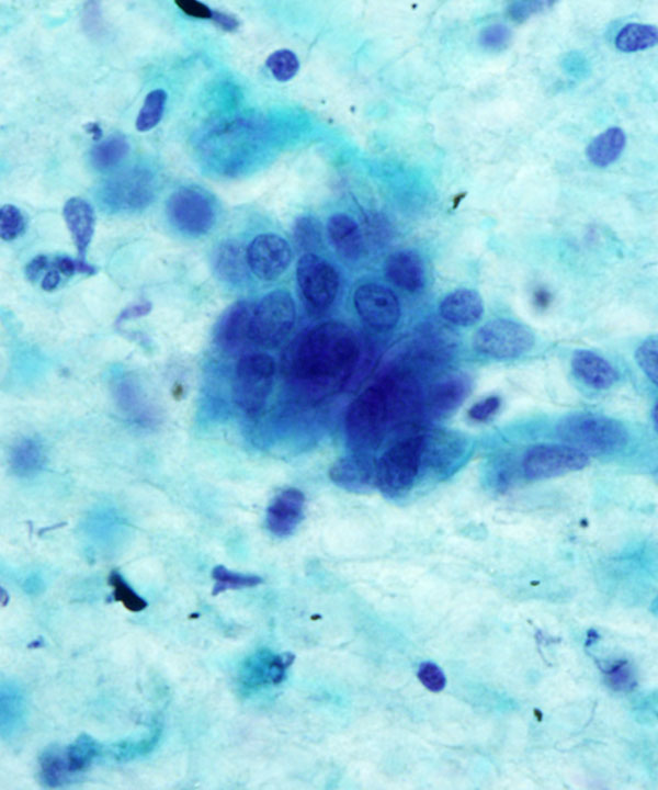 12 : Bone Soft Tissue Chondrosarcoma