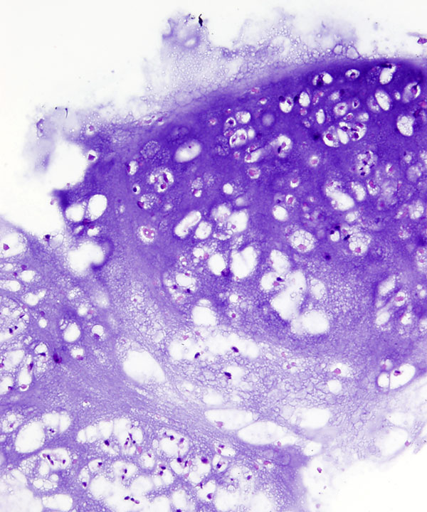 14 : Bone Soft Tissue Chondrosarcoma