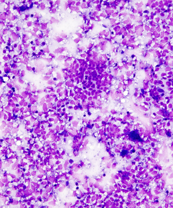 image showing 'Clear Cell Sarcoma'