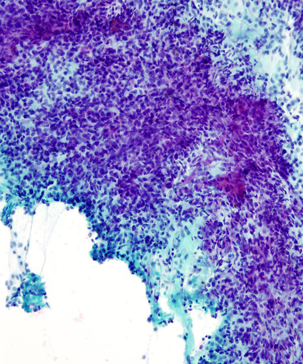 03 : Bone Soft Tissue Clear Cell Sarcoma