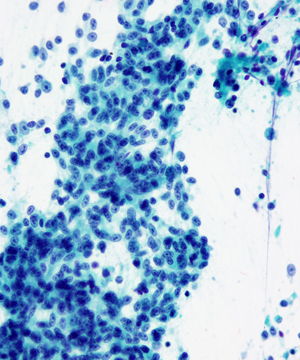 04 : Bone Soft Tissue Clear Cell Sarcoma