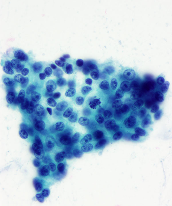 06 : Bone Soft Tissue Clear Cell Sarcoma