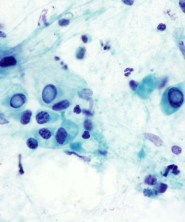 09 : BoneSoft Tissue Epithelioid Hemangioendothelioma