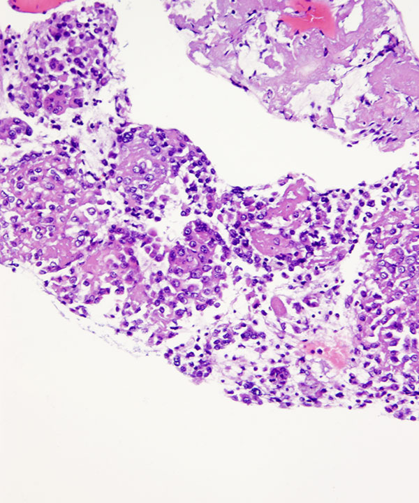 10 : BoneSoft Tissue Epithelioid Hemangioendothelioma