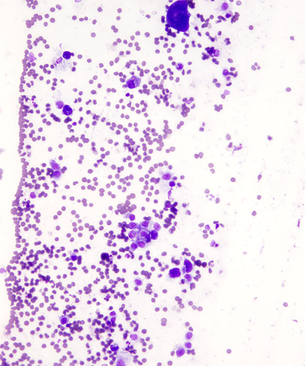 02 : Bone Soft Tissue Epithelioid Sarcoma