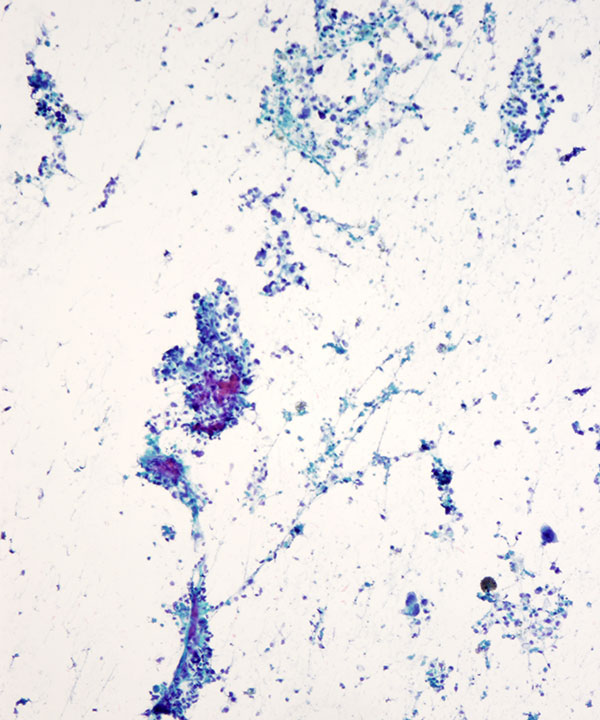 05 : Bone Soft Tissue Epithelioid Sarcoma