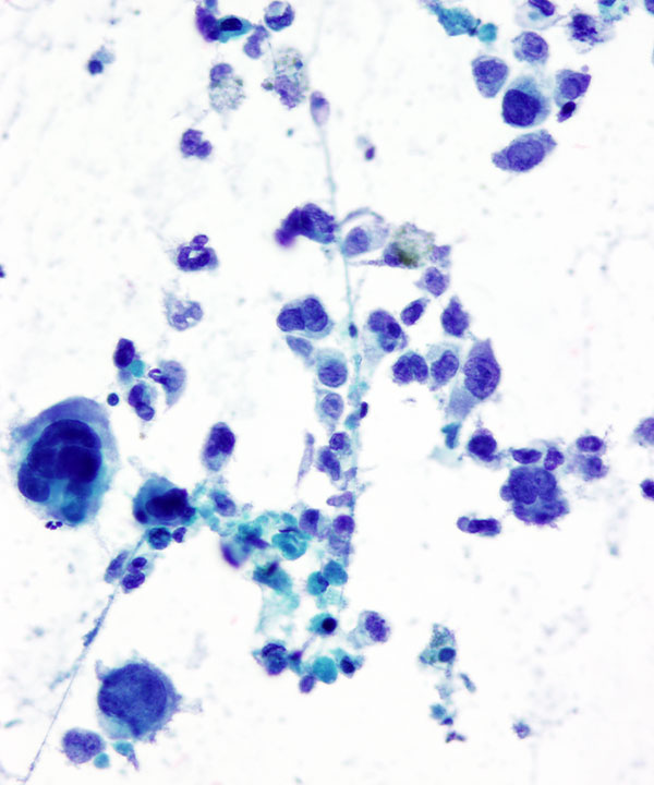 07 : Bone Soft Tissue Epithelioid Sarcoma