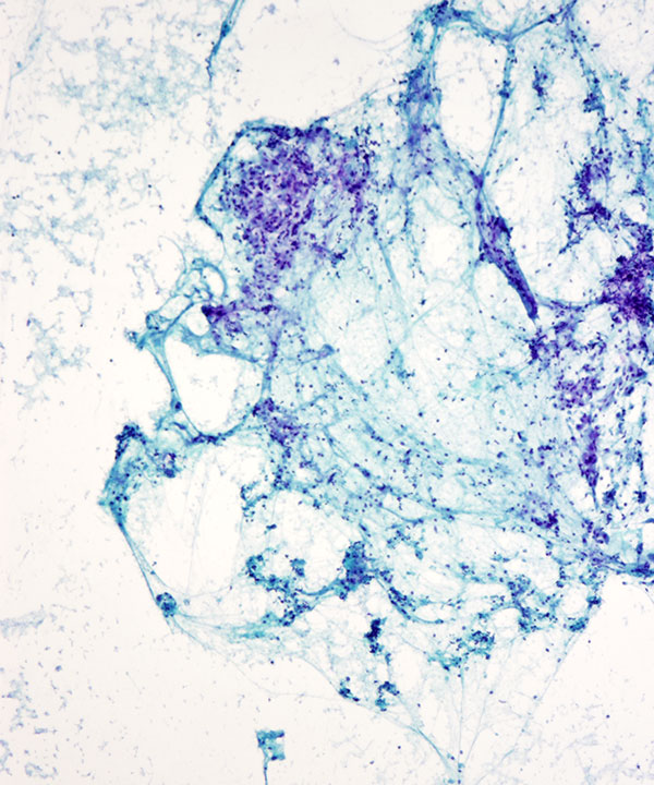 image showing 'Granular Cell Tumor'