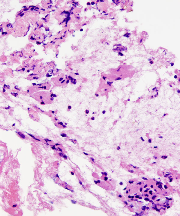 05 : BoneSoft Tissue Granular Cell Tumor
