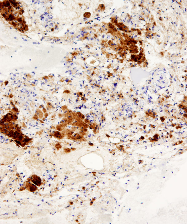 06 : BoneSoft Tissue Granular Cell Tumor