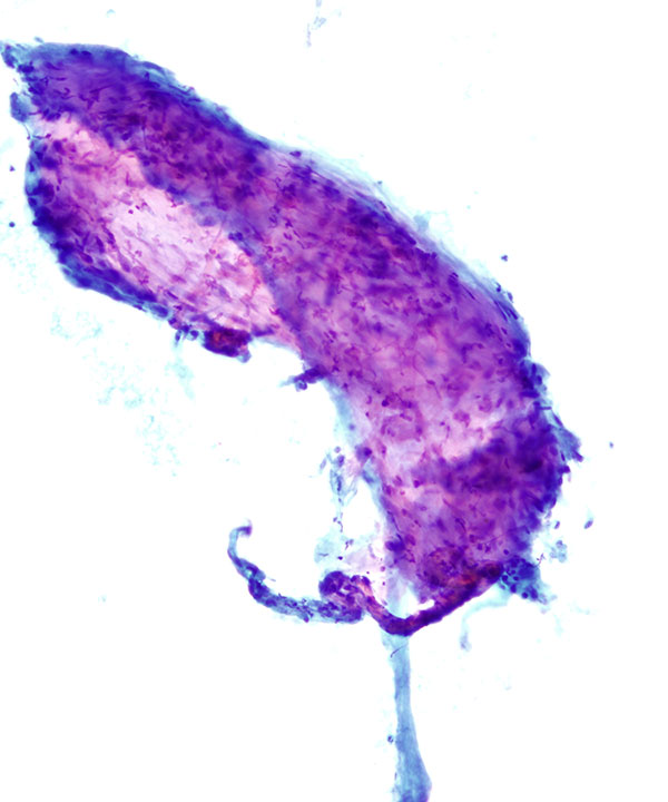 03 : Bone & Soft Tissue Hemangioma