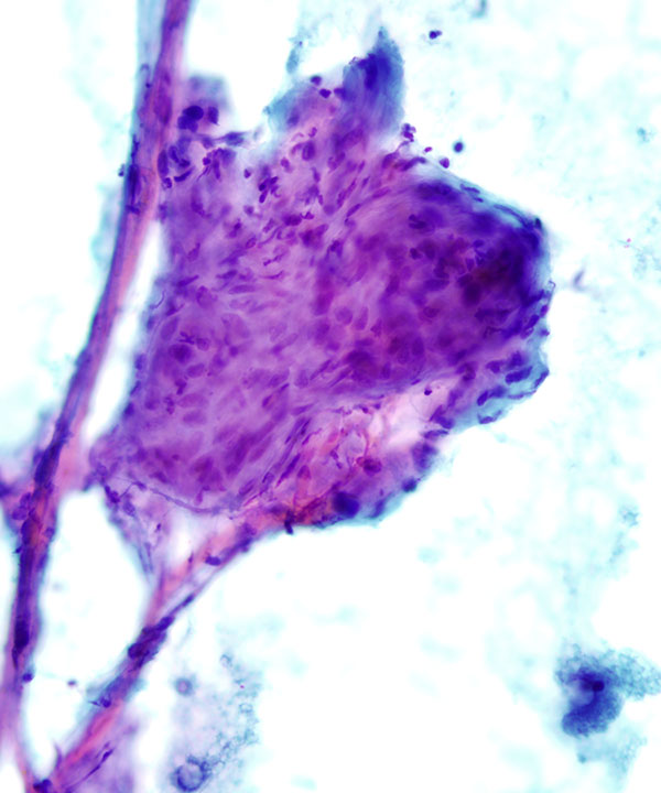 05 : Bone & Soft Tissue Hemangioma