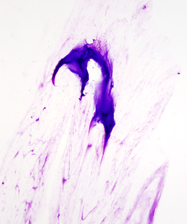 image showing 'Osteochondroma'