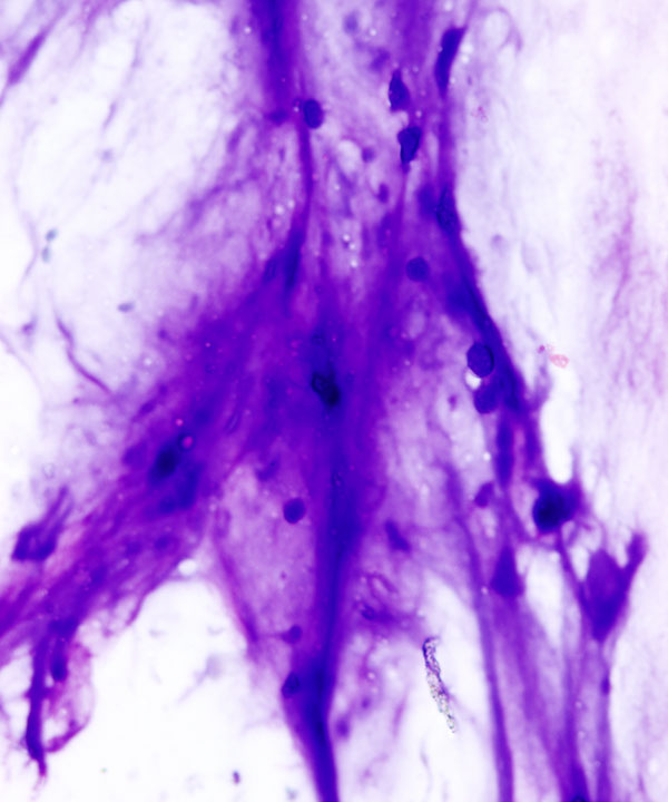 03 : Bone Soft Tissue Osteochondroma