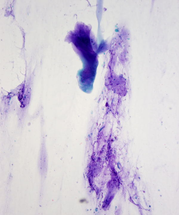 04 : Bone Soft Tissue Osteochondroma