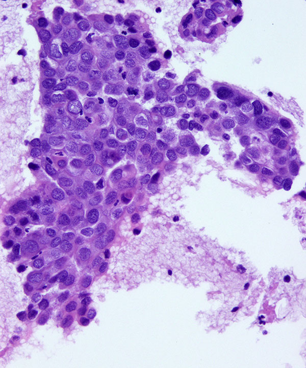 5 : Breast Ductal Carcinoma
